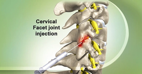 Cervical facet joint injection