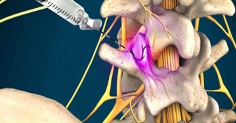 Medial branch nerves injection process
